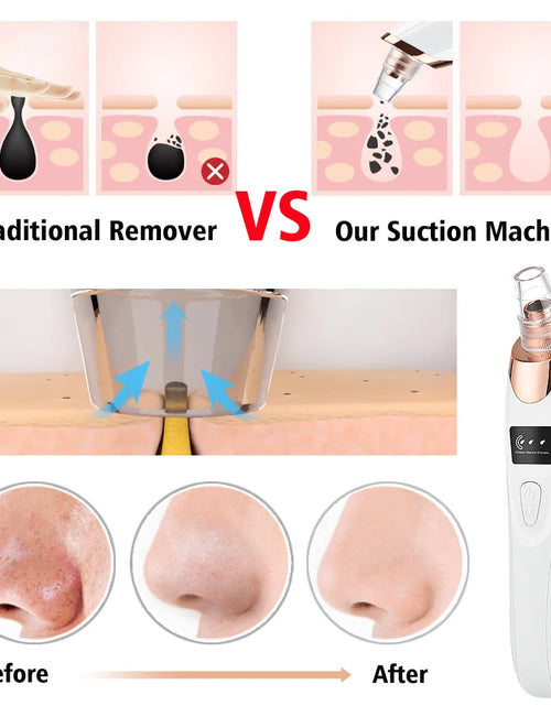 Load image into Gallery viewer, Vacuum Suction Blackhead Remover Acne Needle Set Facial Pore Cleaner Black Spots Acne Pimple Black Head Extractor Skin Care Tool
