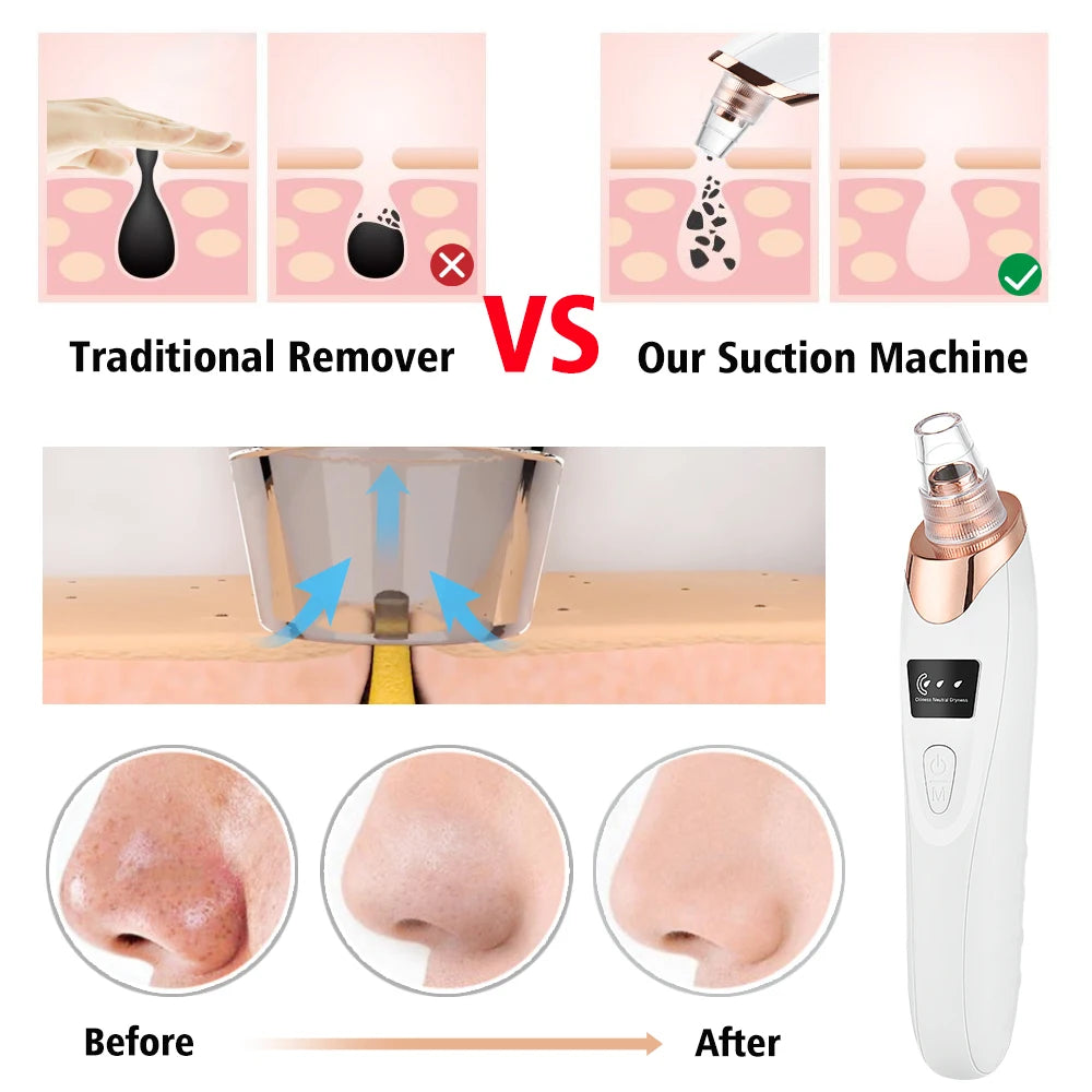 Vacuum Suction Blackhead Remover Acne Needle Set Facial Pore Cleaner Black Spots Acne Pimple Black Head Extractor Skin Care Tool